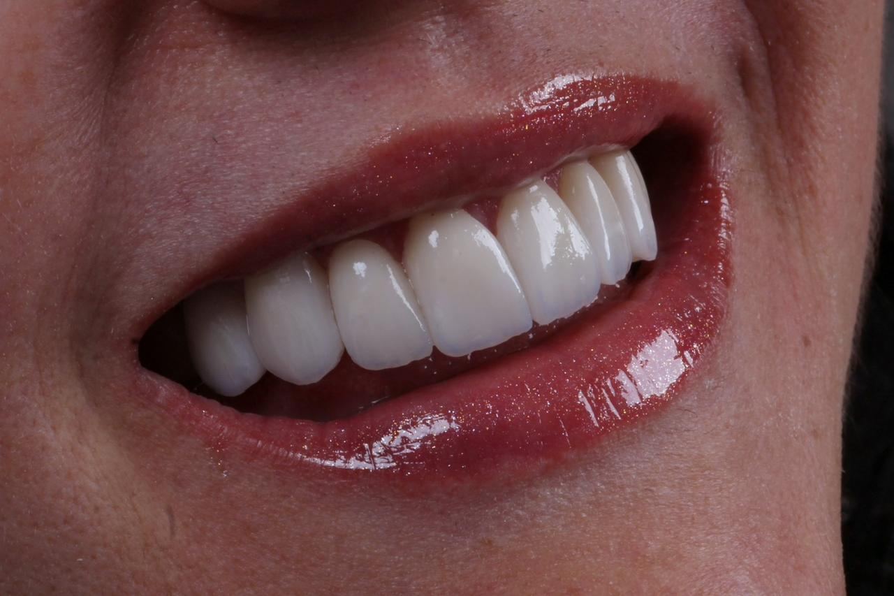 Detalhe de dentes restaurados