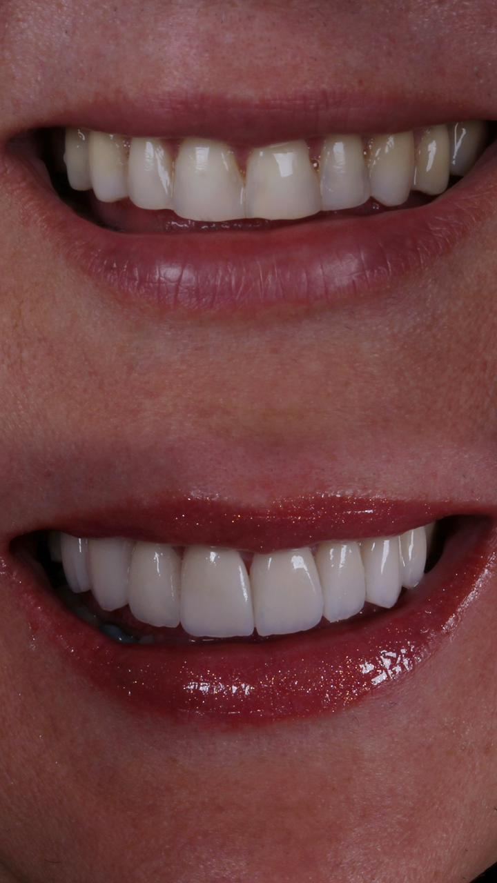 Comparativo de antes e depois do sorriso